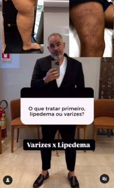 Varizes e Lipedema: Qual Tratar Primeiro?